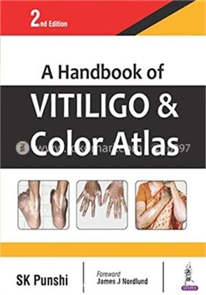 A Handbook of Vitiligo and Colour Atlas