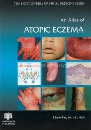 An Atlas of Atopic Eczema