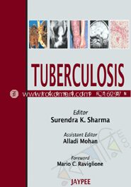 Tuberculosis